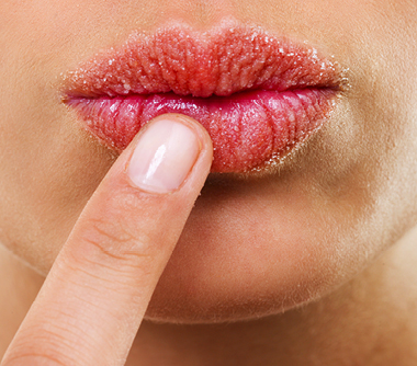 Chapped Lips Condition - Image