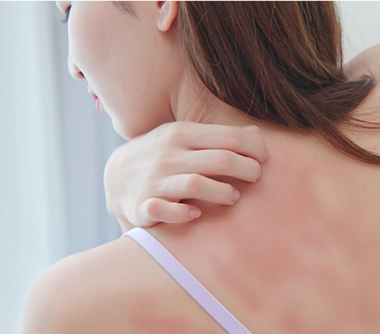 Eczema & dermatitis Condition - Image