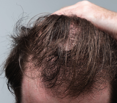 Hair Loss Condition - image