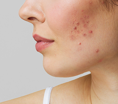acne-condition