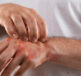 Diagnosing the different types of Psoriasis