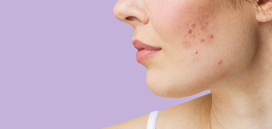 A woman with acne on her cheek on a purple background