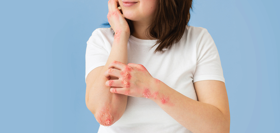 What's The Difference between Eczema vs Psoriasis - a woman in a white tshirt has eczema on her arms and she is itching it.