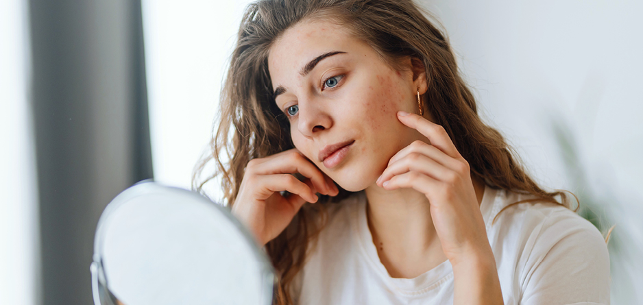 A girl looking in the mirror wondering Acne Cream vs. Acne Lotion: Which One Works Better?