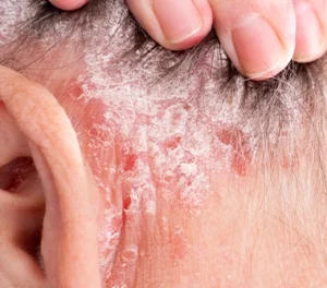 Erythrodermic Psoriasis behind a persons ear