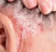 Erythrodermic Psoriasis behind a persons ear