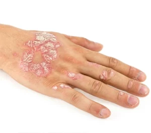 Pustular Psoriasis on the back of a persons hand