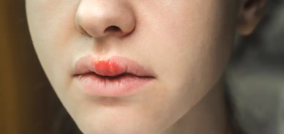 Dermal Therapy Cold Sore Cream - Lysine Gel