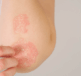 A close-up of a person's arm displaying a patch of psoriasis and fingers just about to scratch it.