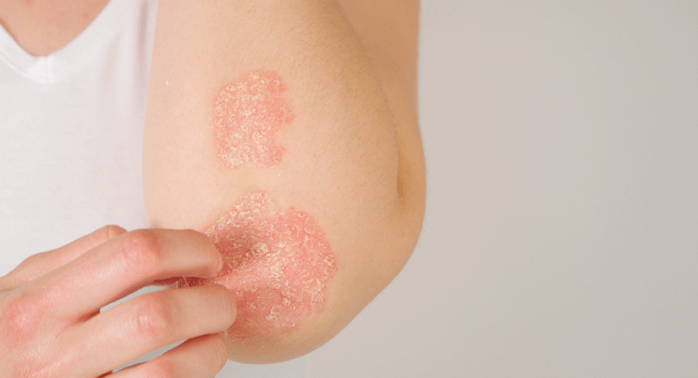 A close-up of a person's arm displaying a patch of psoriasis and fingers just about to scratch it.
