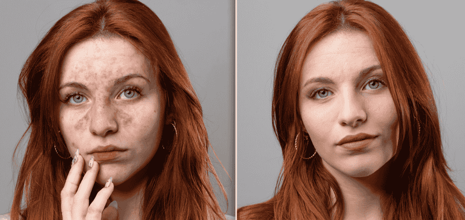 The Ultimate Guide to Face & Eyelid Eczema