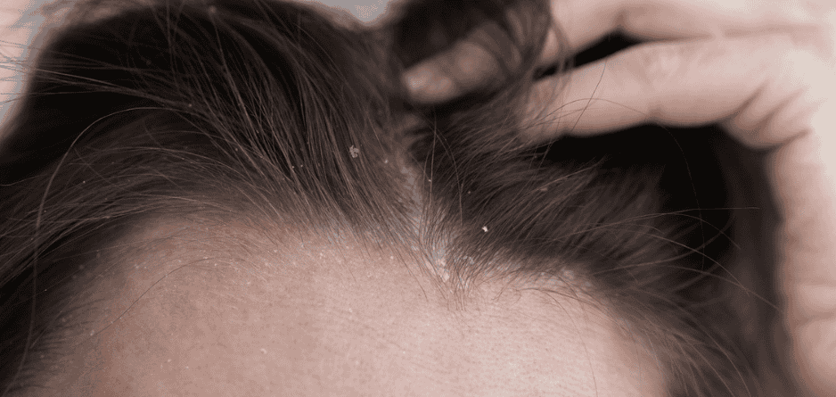 A close up of a person itching their head - Understanding the Causes of Itchy Scalp: Common Triggers and Remedies