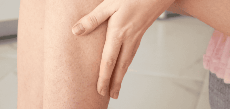 Urea Rash Skin Urea for Specific Skin Conditions: Eczema, Psoriasis, KP