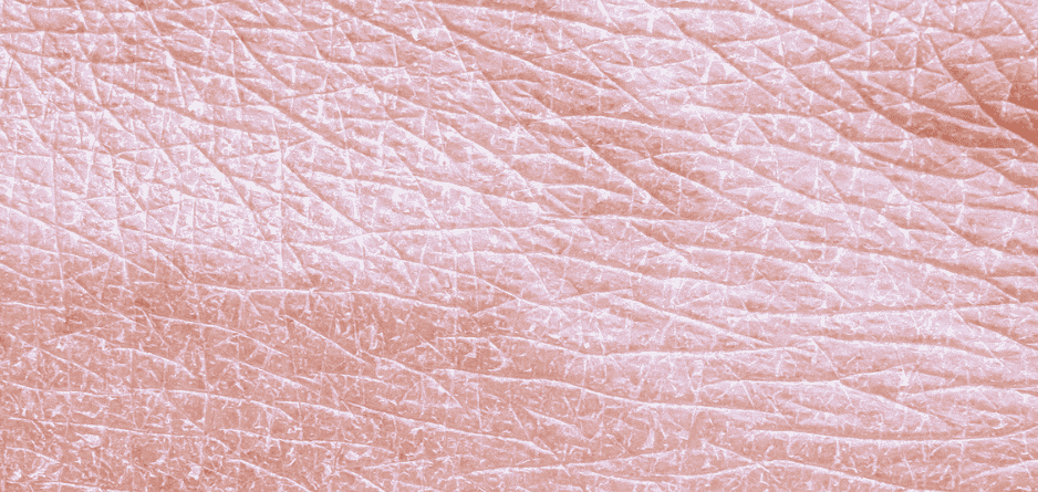 Xerosis or Very Dry Skin