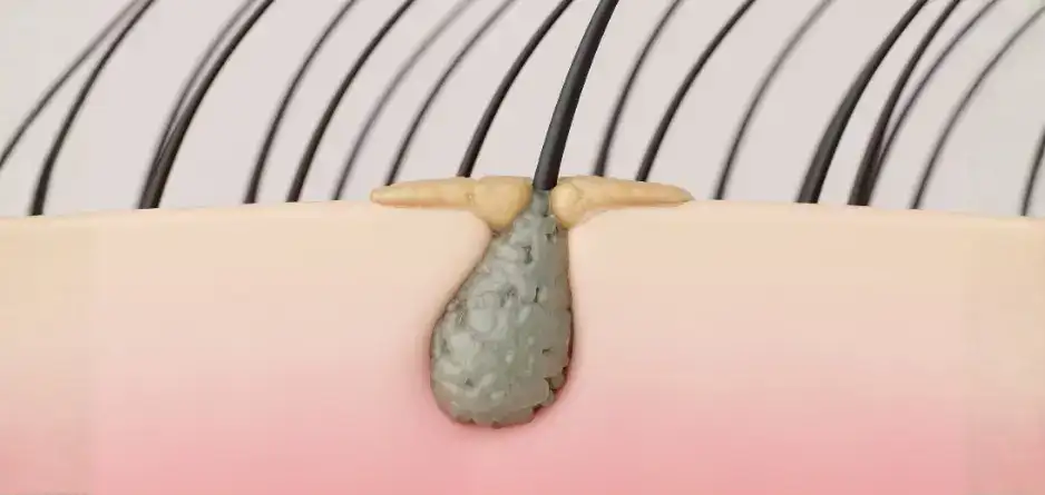 A hair root in a scalp showing scalp sebum build up