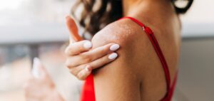 A woman in a red tank top applying Dermal Therapy Dry Skin products to her severe dry skin - Xerosis