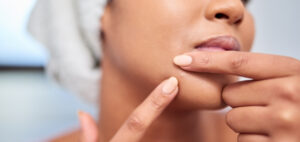 A person squeezing a spot and wondering if Pimple Patches actually work