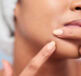 A person squeezing a spot and wondering if Pimple Patches actually work