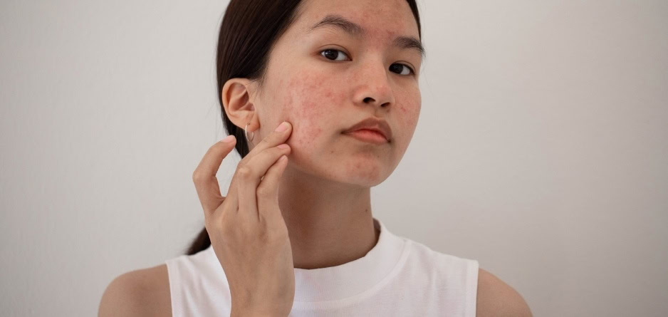 A girl with acne on her cheek touching it - thinking about acne treatment