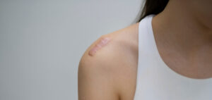 A woman in a white vest with a scar on her shoulder - thinking about improved scar management