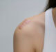 A woman in a white vest with a scar on her shoulder - thinking about improved scar management