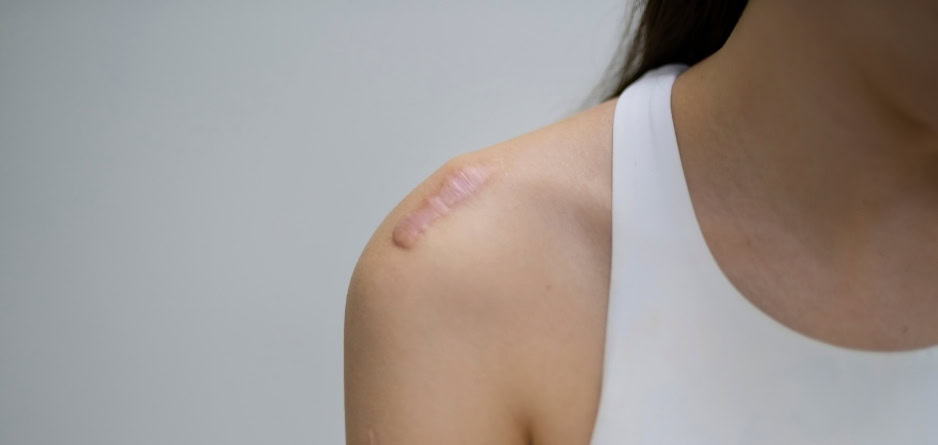 A woman in a white vest with a scar on her shoulder - thinking about improved scar management