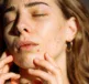 Sunscreen for Acne-Prone Skin - Why You Need It - Dermal Therapy