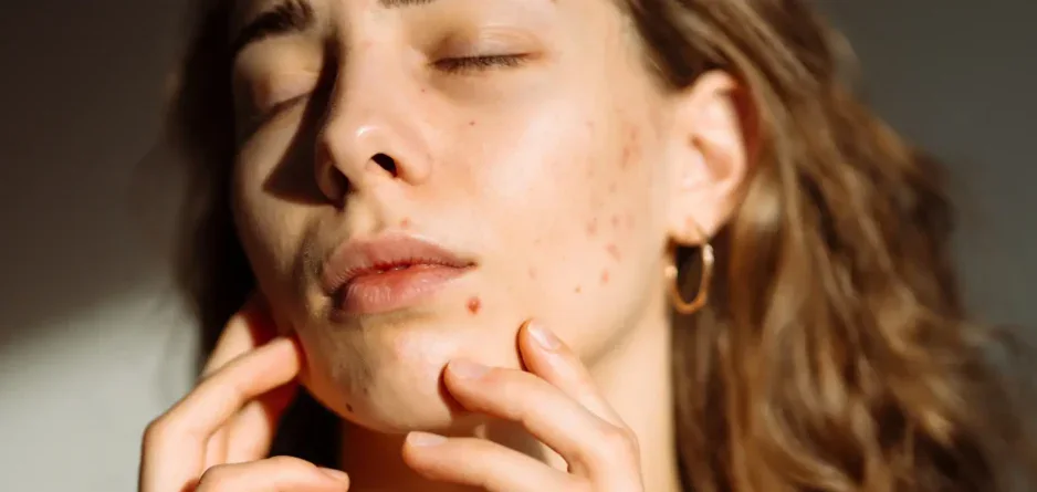Sunscreen for Acne-Prone Skin - Why You Need It - Dermal Therapy